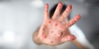Boom di casi di morbillo nel Salento: l’Asl di Lecce lancia l’allarme